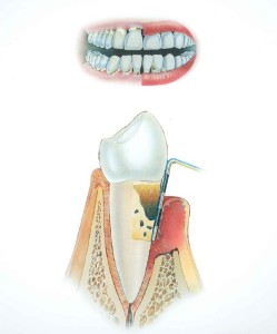 Parodontite Torino gengivite cura gengive infiammate